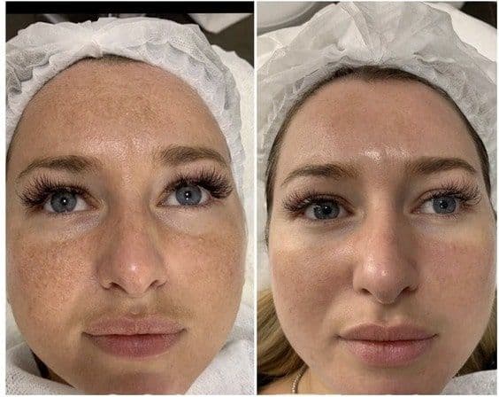 Мезотерапия лица Биоревитализация 35$ — 2