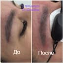 Удаление старого татуажа