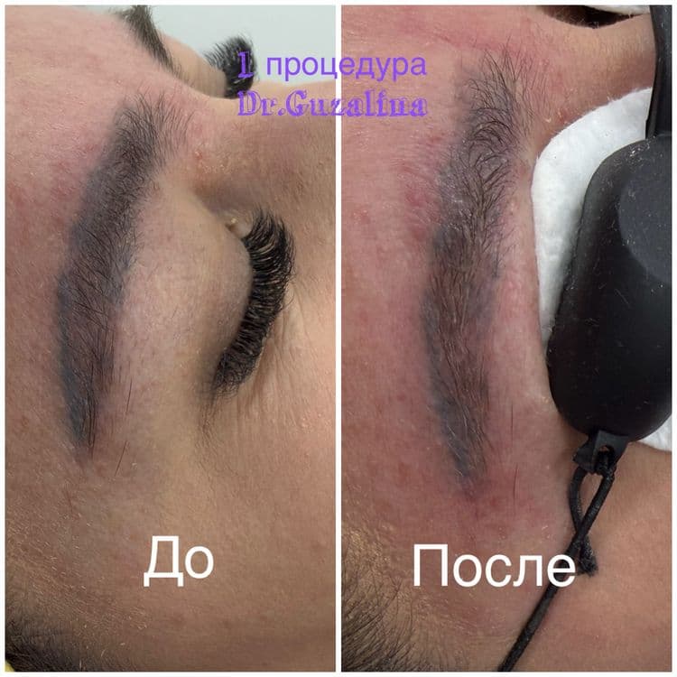 Удаление старого татуажа — 1