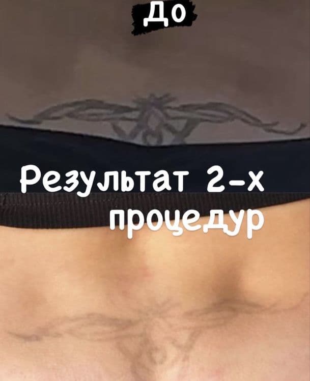 Удаление татуаж  татуировок за 2 процедуры безболезненно — 1