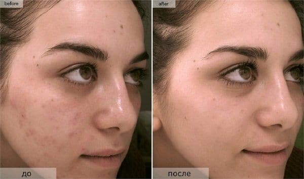 Карбоновый пилинг. Удаление перманентного макияжа. Удаление татуажа — 4
