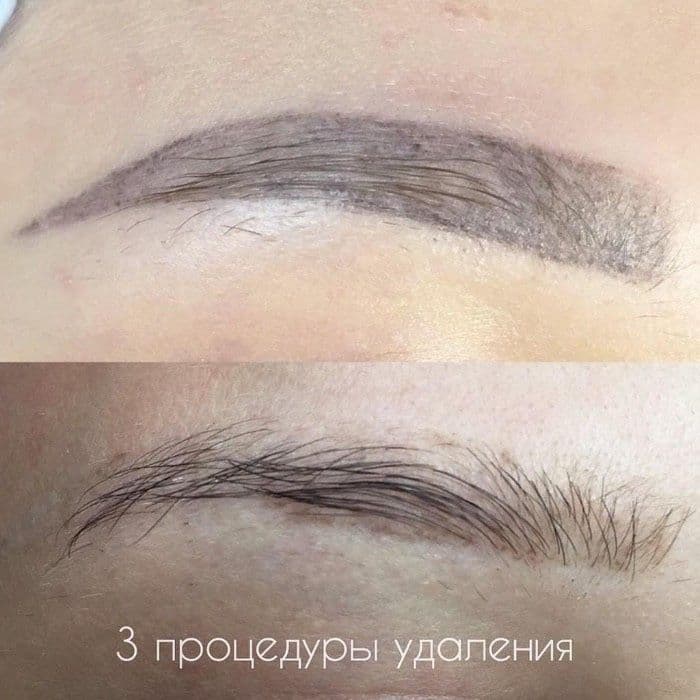 Удаление татуажа и татуировок лазером и ремувером — 1