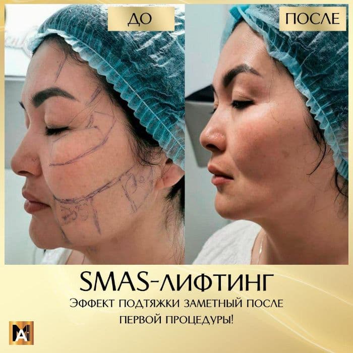 SMAS лифтинг. Безоперационная подтяжка лица. Ультразвуковой лифтинг. — 1