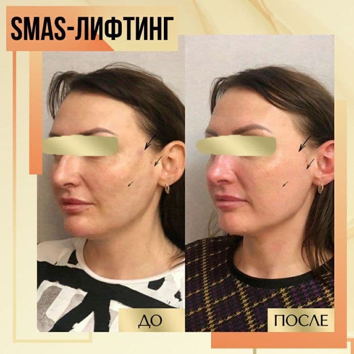 SMAS лифтинг. Безоперационная подтяжка лица. Ультразвуковой лифтинг. — 2
