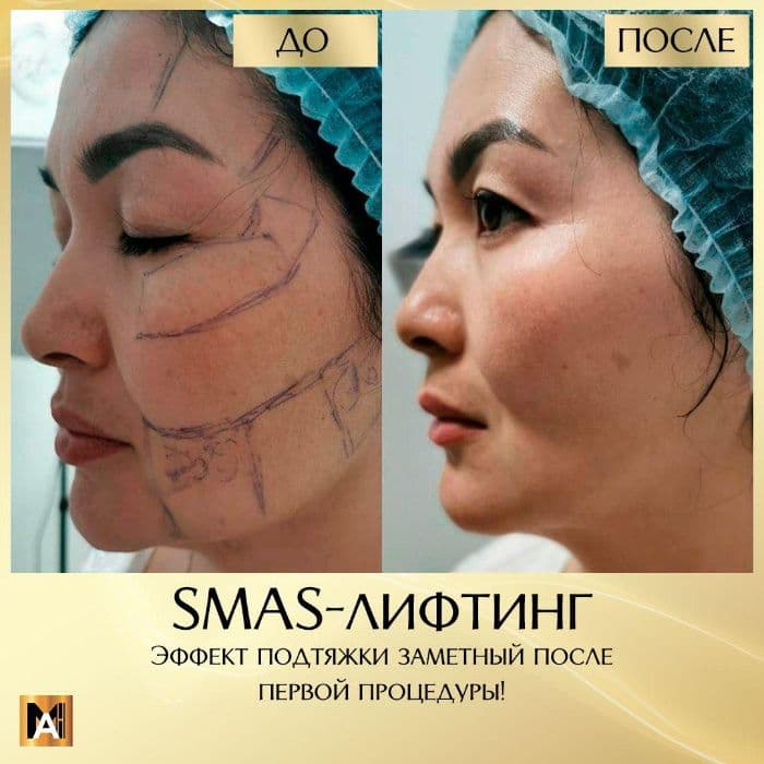 SMAS лифтинг. Безоперационная подтяжка лица. Ультразвуковой лифтинг. — 3