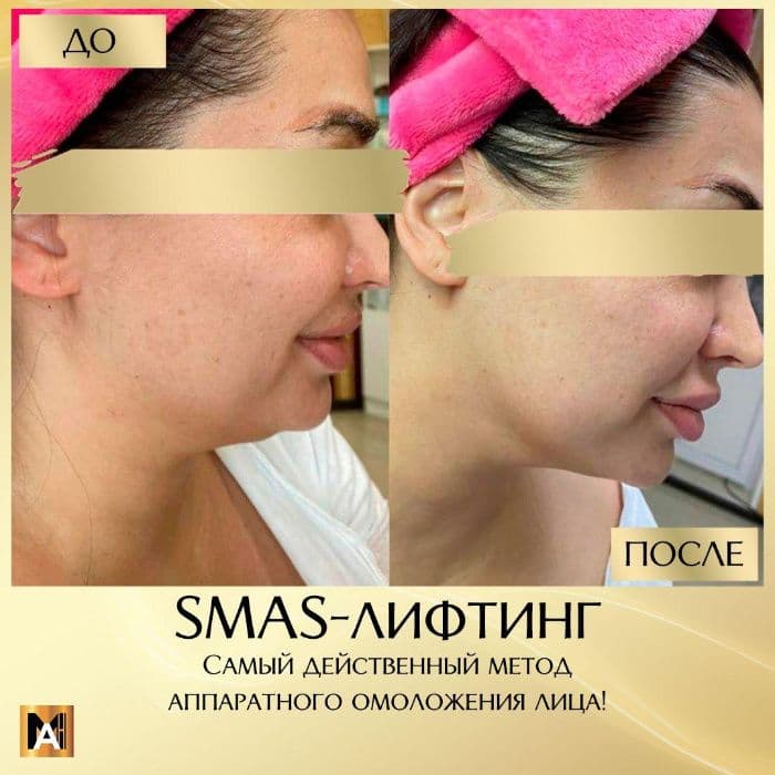 SMAS лифтинг. Безоперационная подтяжка лица. Ультразвуковой лифтинг. — 4