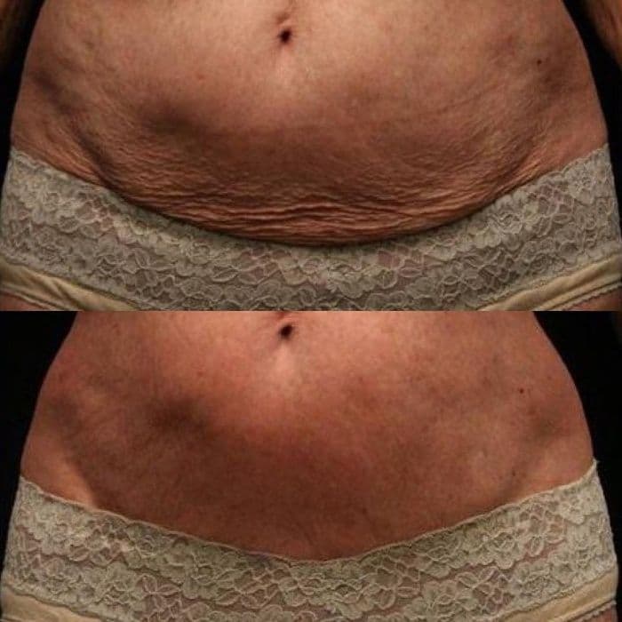 Liposonix. Безоперационная липосакция! — 1
