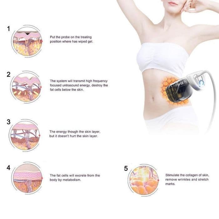 Liposonix. Безоперационная липосакция! — 2