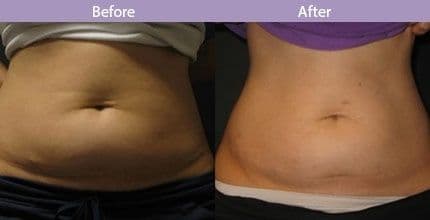 Liposonix. Безоперационная липосакция! — 3