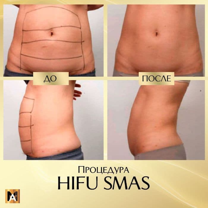 Liposonix. Безоперационная липосакция! — 4