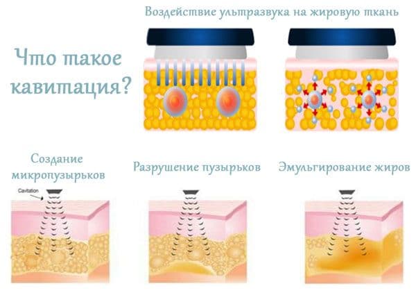 Ультразвуковая липосакция тела (Кавитация) — 3