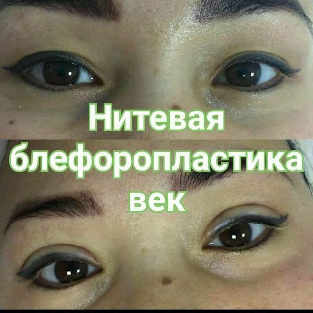 Блефаропластика верхних и нижних век — 6