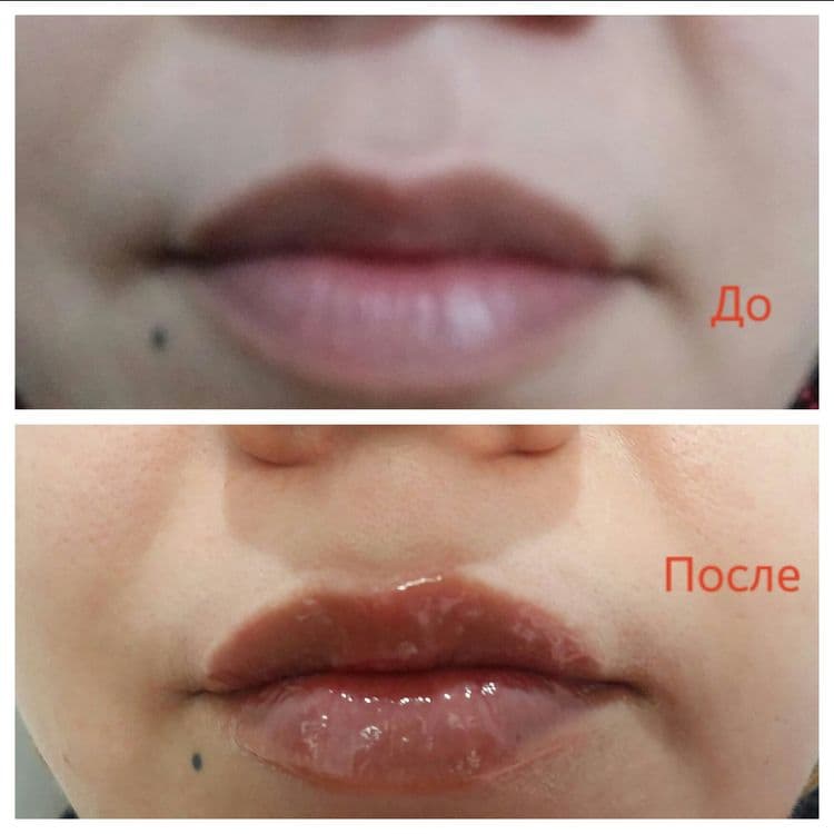 Губы,ботокс в Ташкенте — 2