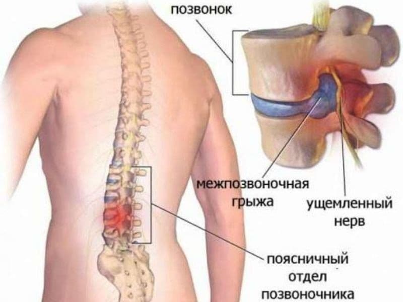 Корсет для спины ортопедический для грыжи спины, пояснично-крестцовый — 5