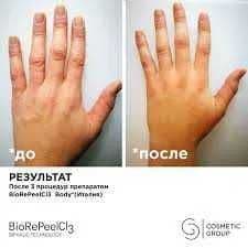 Срединный пилинг, 6мл (на 5 процедур). Италия. BioRePeel Оригинал! — 5