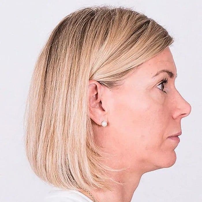 Bernafon Entra A2 MiniRITE (MNR) eshitish apparati/Orginal/Kichkina — 5