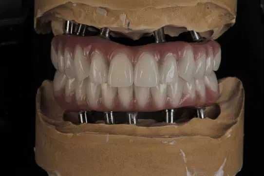 CAD/CAM технология — зубной техник за одно посещение Стоматология Зубы — 1