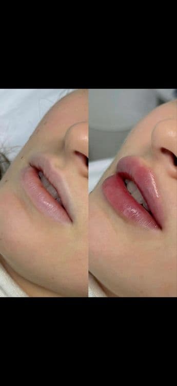 Увеличение губ, контурная пластика — 1