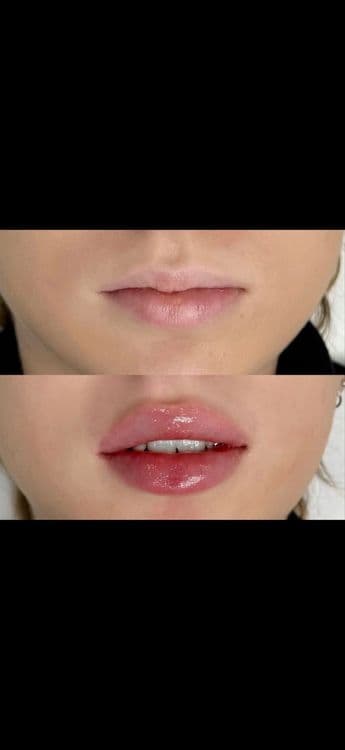 Увеличение губ, контурная пластика — 2
