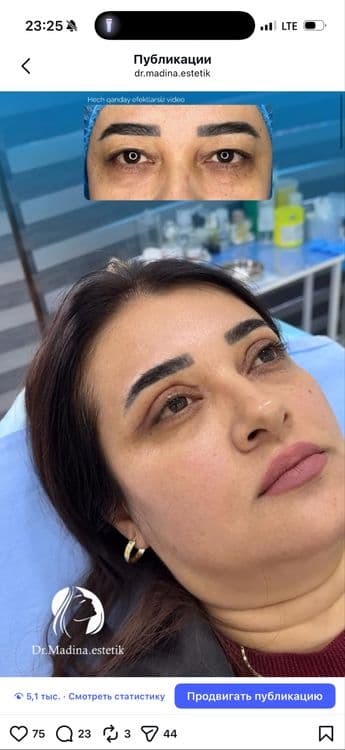 -50% CHEGIRMADA Qovoqlar Blefaroplastikasi — 3
