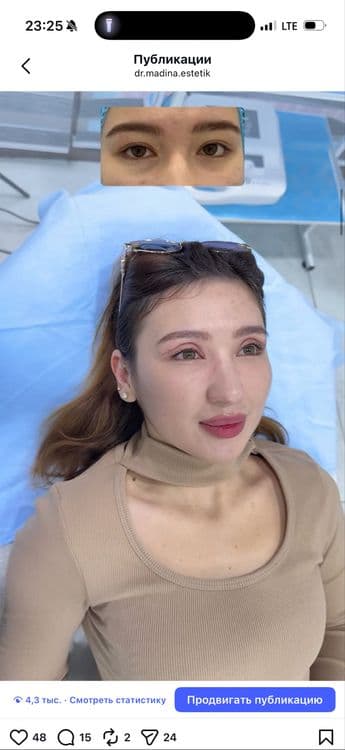-50% CHEGIRMADA Qovoqlar Blefaroplastikasi — 4