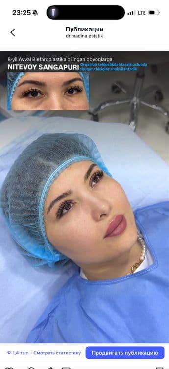 -50% CHEGIRMADA Qovoqlar Blefaroplastikasi — 5