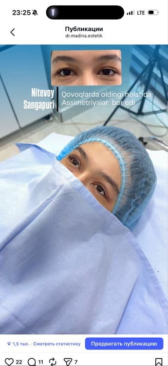 -50% CHEGIRMADA Qovoqlar Blefaroplastikasi — 6