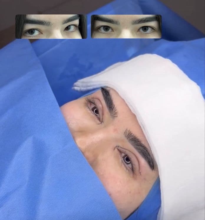 -50% CHEGIRMADA Qovoqlar Blefaroplastikasi — 7