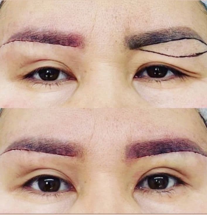 -50% CHEGIRMADA Qovoqlar Blefaroplastikasi — 8
